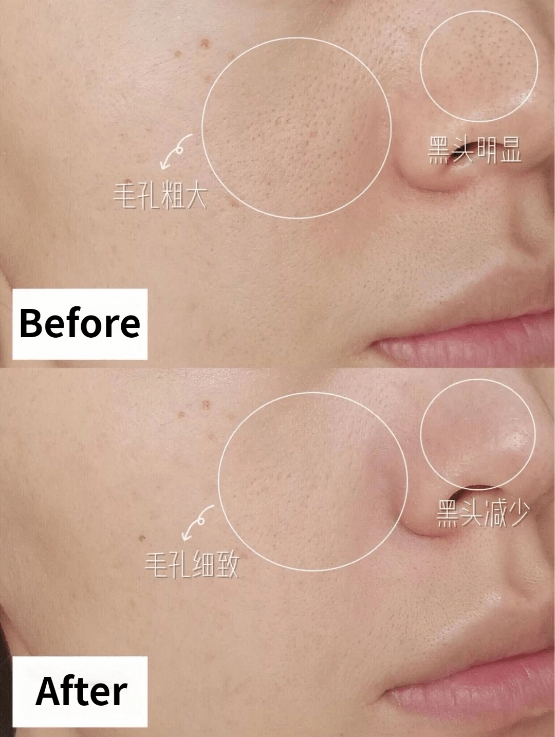 毛孔|鼻子脏到挤出“白条条”?照我这样做,脸上啥脏东西都溶掉!