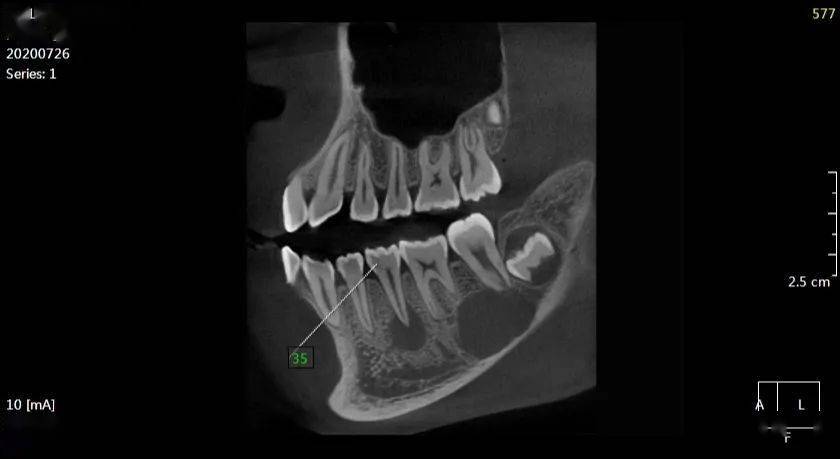 白xx 20200726 囊肿cbct 138xxxx5266
