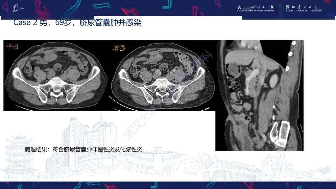 实例解析脐尿管病变影像诊断