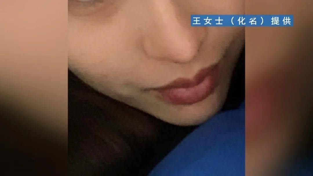 伤口|慎点！女子隆鼻手术后，伤口反复流出脓液！结果…