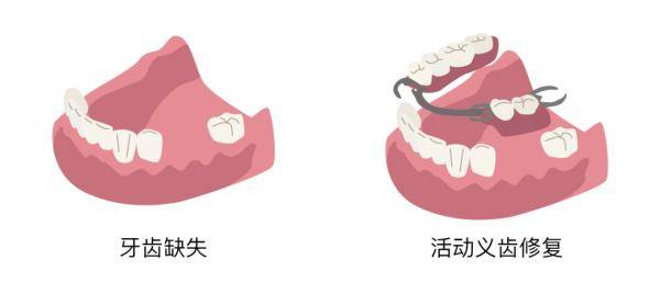 牙冠坏了怎么办