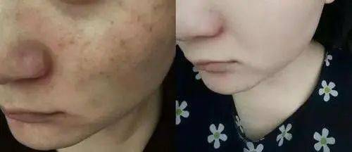 肌肤|皮肤油腻的元凶竟是它！补水保湿，99%的人用错了！