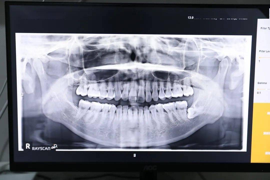 口腔|整牙比整容还要厉害？不动刀，不打针，悄悄变美的秘密就在这里！