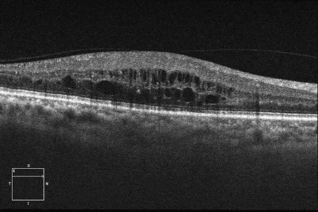 黄斑水肿明显,少许
