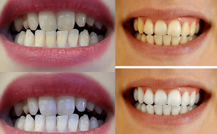 牙膏|牙黄真的太毁颜值！连涂口红都没人家好看