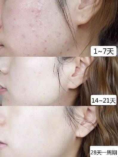 肌肤|脸上挤出的“白浆”是什么？原来是它作怪！出油、过敏也因此而起！