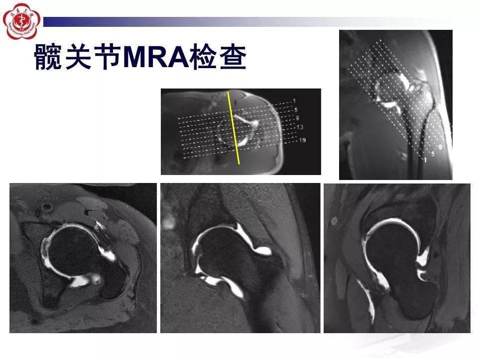 髋关节mr造影方法