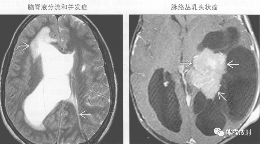 胎儿脑室不对称怎么办