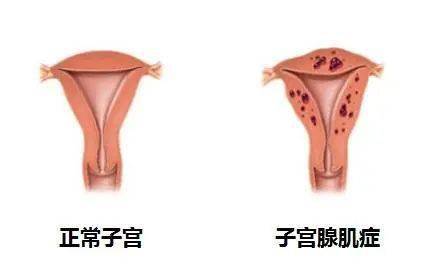 你了解子宫常见的这三种病变吗?_症状