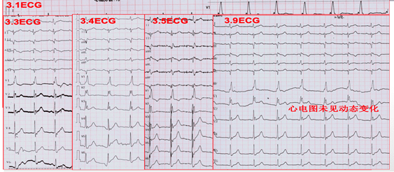 患者|cTNI最高达1.78ng/mL,一定是急性心梗吗?