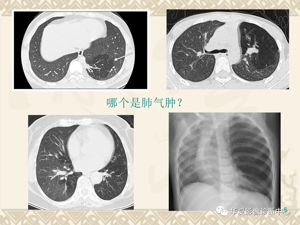 影像基础课丨肺气肿及气道疾病的影像学表现