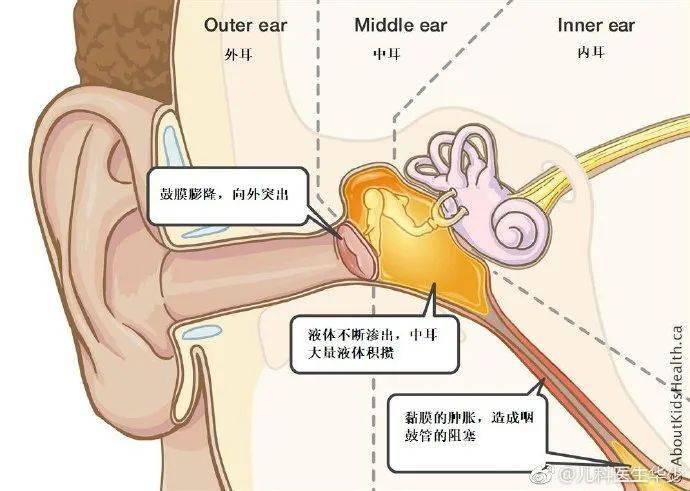 搭飞机耳朵痛怎么调节_耳朵里面痛怎么回事儿