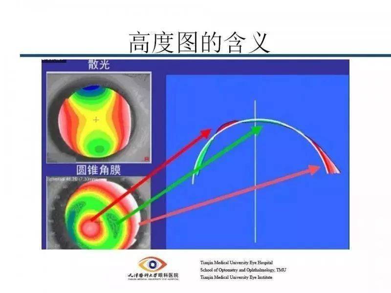 【眼视光】 角膜地形图阅读及基本使用