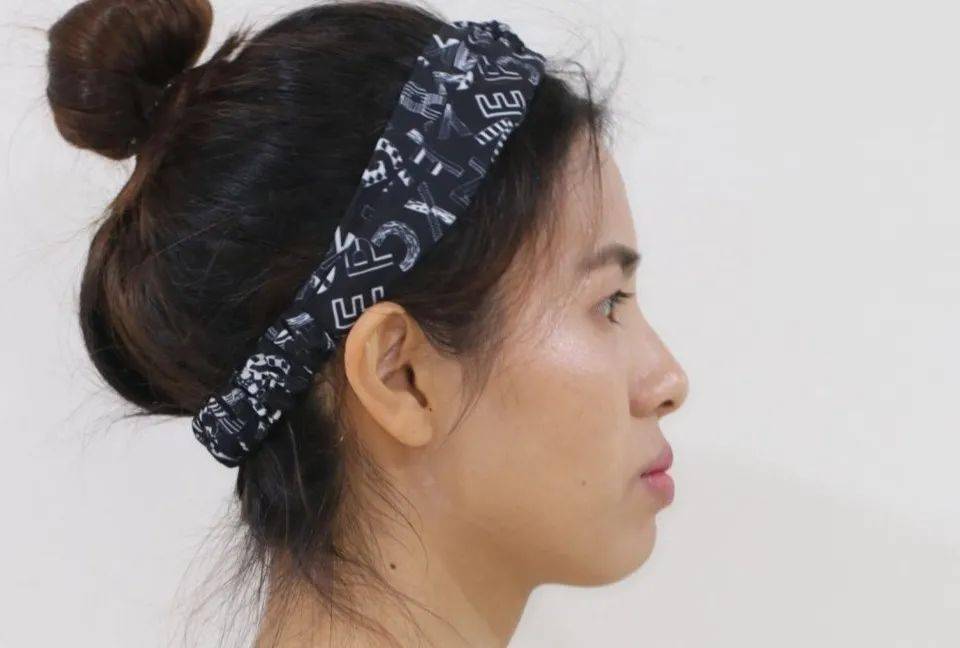 龅牙|广州95后女生从小龅牙，嘴巴都快闭不上！朋友却劝她不要矫牙，一年后......