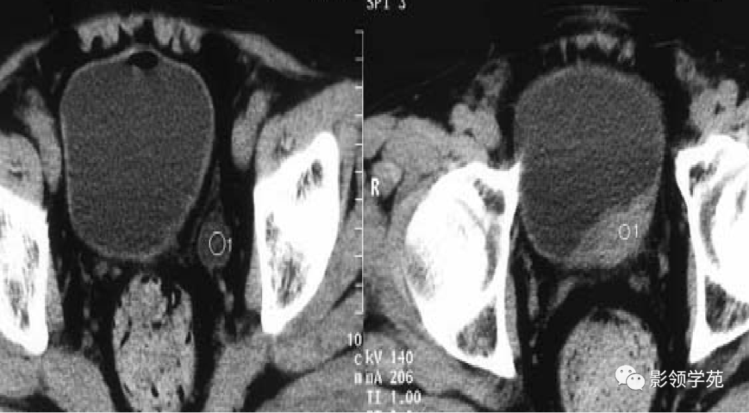 膀胱癌影像表现