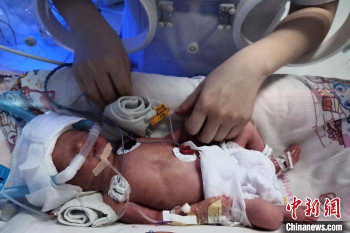 自然|湖北宜昌产妇诞下罕见龙凤四胞胎