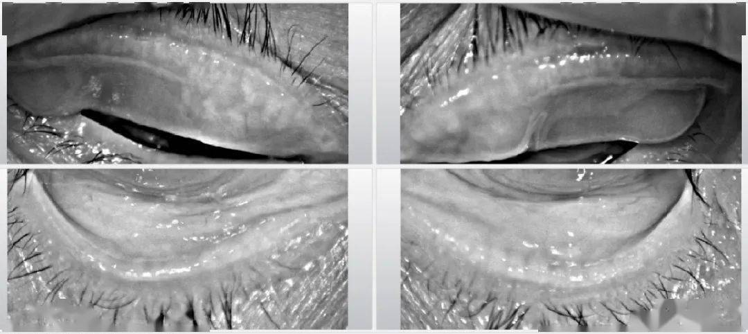 【眼睑螨虫】眼睛反复红痒,长肿粒!16岁少女的睑板腺宛如80岁的老人