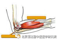 肱骨外上髁炎的速效治疗