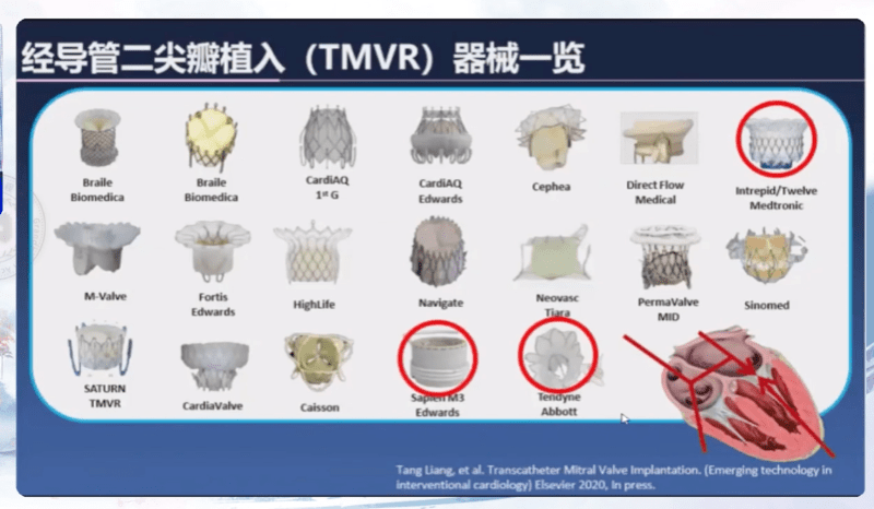 华教授|CCCP 2020｜周胜华教授：二尖瓣治疗术的未来新发展