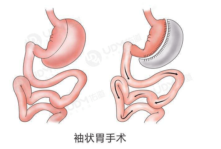 自律|杨天真自曝切胃：自律到崩溃后，她认输了