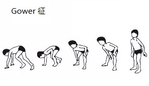 进行性肌营养不良症能活到几岁 28f890f5db774bebbab88e8f40b3734e.png