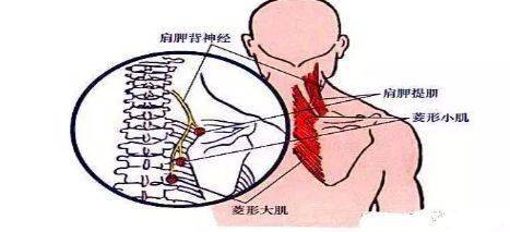 详解颈部肌筋膜性疼痛