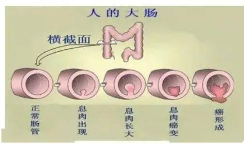 大肠癌的发生发展过程 便血,腹痛,包块.