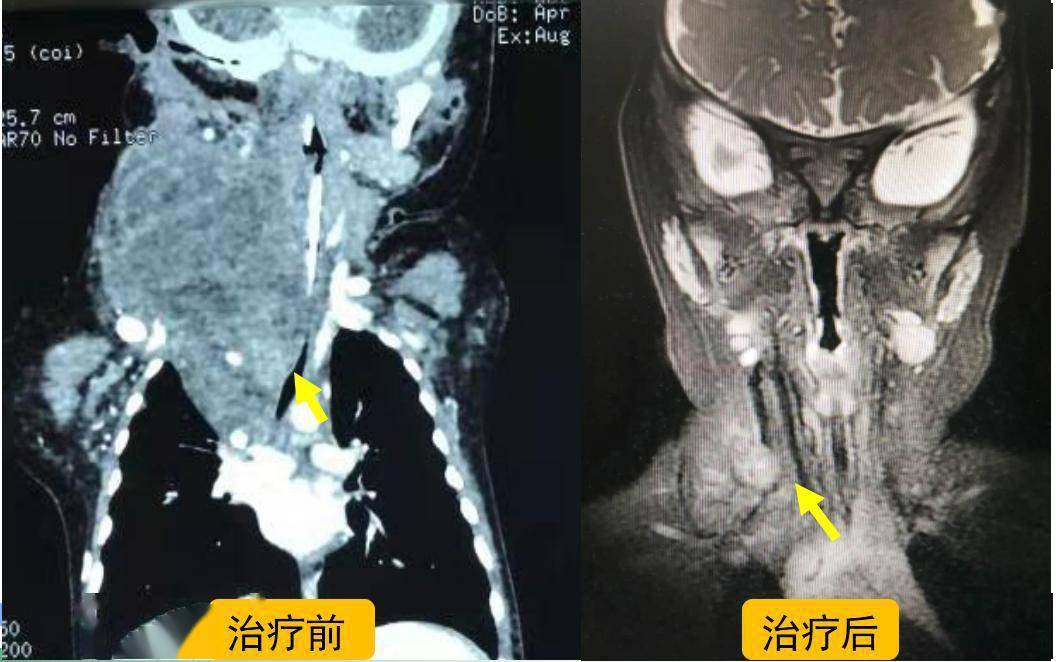 颈胸部淋巴管畸形病例3:6岁男孩,食道横纹肌瘤,6月龄开始吞咽困难