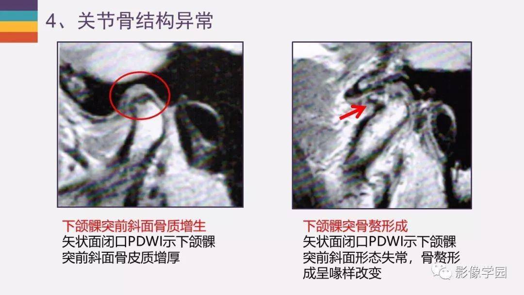 颞颌关节病变的mri诊断