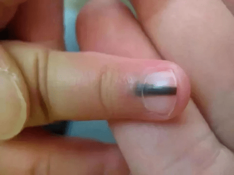 白点|孩子指甲上的月牙、白点、竖纹、分层、咬指甲......是有大病的征兆？