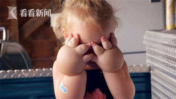 淋巴|2岁“金刚芭比”双手肿成拳套 孩子出生就患怪病