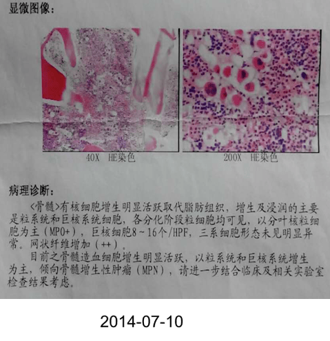 原发性骨髓纤维化诊疗知多少?