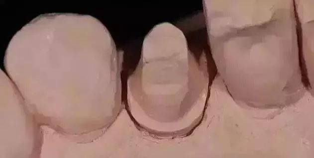 怎么才能让牙冠保持密合 a8d5b171feea42b899348d80e9c60400.jpeg