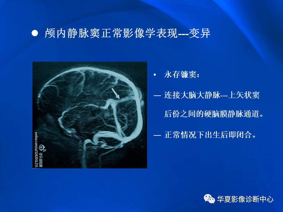 学习不倦颅内静脉窦血栓形成的影像学表现