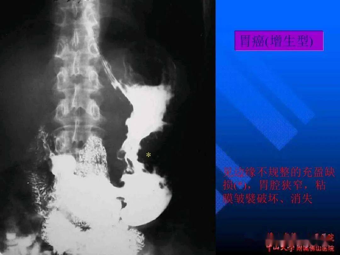 超详细的消化道造影正常与异常影像图解