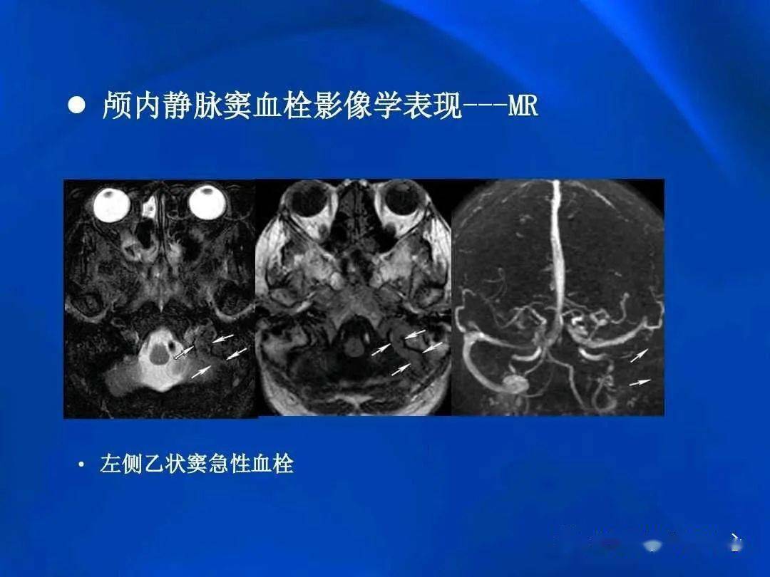 颅内静脉窦血栓形成的影像学表现