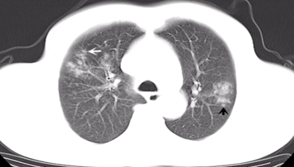 识别|肺部 CT 秒杀:快速识别各类影像