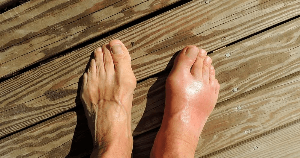 肾脏|上厕所时，若有这种异常，可能是你体内尿酸高了，需及时控制！