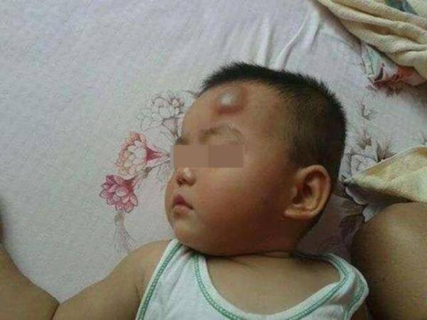 宝宝|家长应该怎么做？提前了解，不耽误治疗“黄金期”宝宝磕到头时