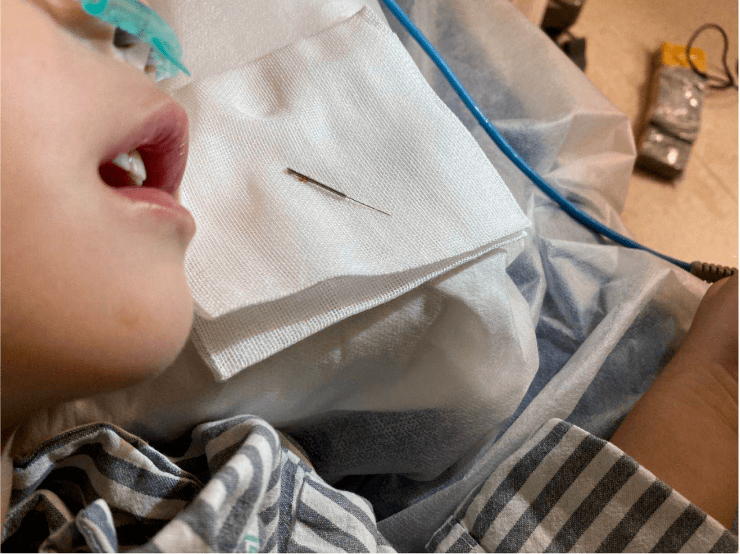 幼儿|广东3岁幼儿误吞4cm灸针！家长吓得哭出声：我太后悔了…