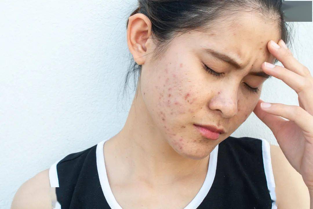 根源|三层遮瑕都遮不掉这烦人的痘印？不如就从根源下手！