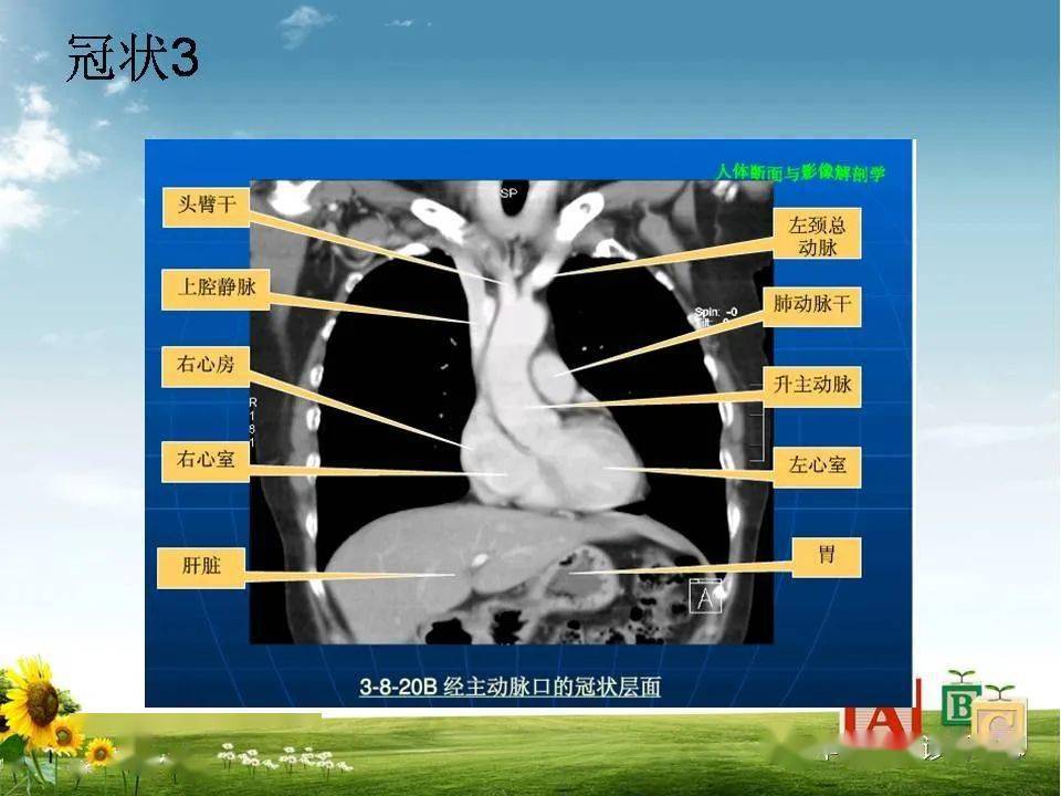 心脏大血管的影像解剖