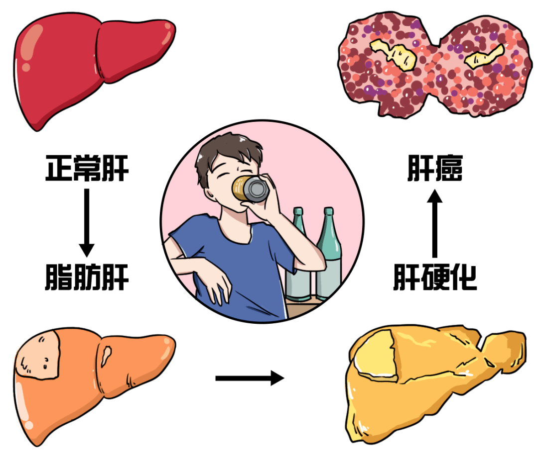 达到10%,属中度脂肪肝; 超过25%,属重度脂肪肝.