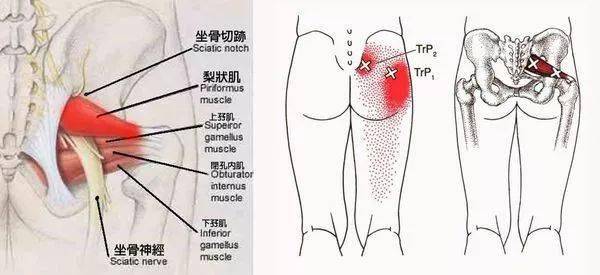 坐骨神经痛到底是梨状肌综合征还是腰椎间盘突出呢辨别与治疗一文搞定