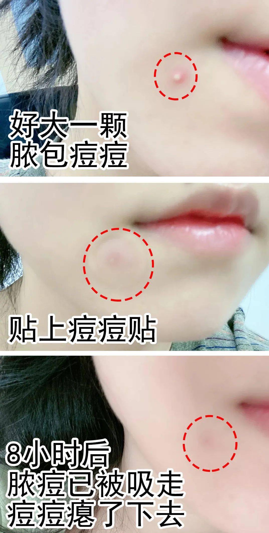 痘痘|“拔”出黄脓，快速消痘！让肌肤变成“白煮蛋”，就是这么简单！
