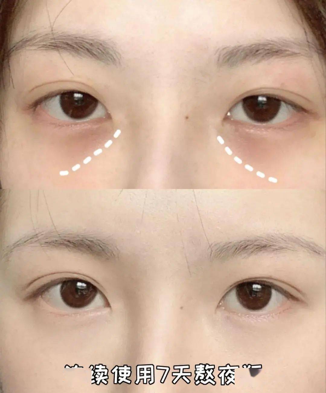 贫民窟|杨幂熬夜后护肤要花2万块？怪不得皮肤吹弹可破！贫民窟女孩就不配消除熬夜痘、黑眼圈吗？