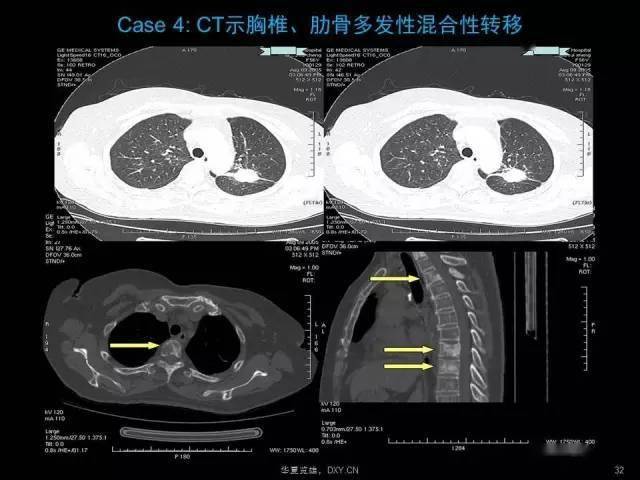 (重磅)肺癌,肺炎,肺结核的影像诊断鉴别