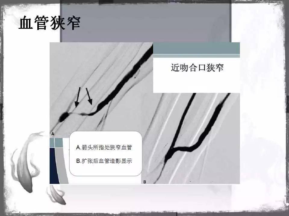 自体|血管通路 | 自体动静脉内瘘成形术