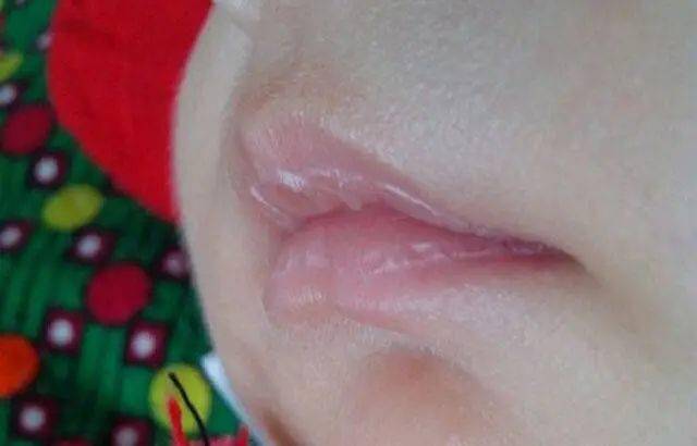 孩子|光喝水就好了吗?最快的方法是这个孩子嘴唇干燥爆皮出血