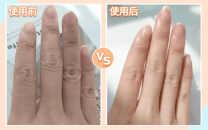 肌肤|因为粗糙的手,丢了颜值还越来越自卑,还好有它拯救了....